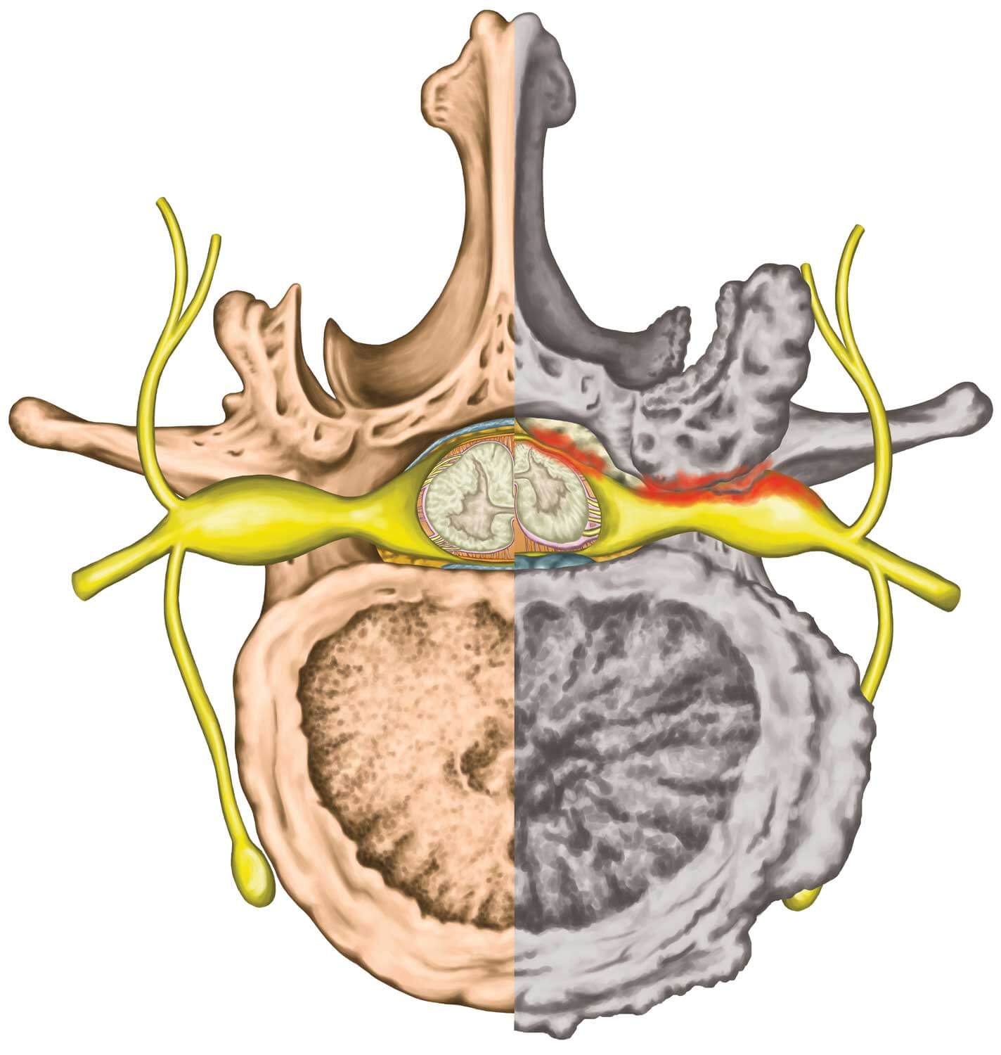 Lumbar Stenosis